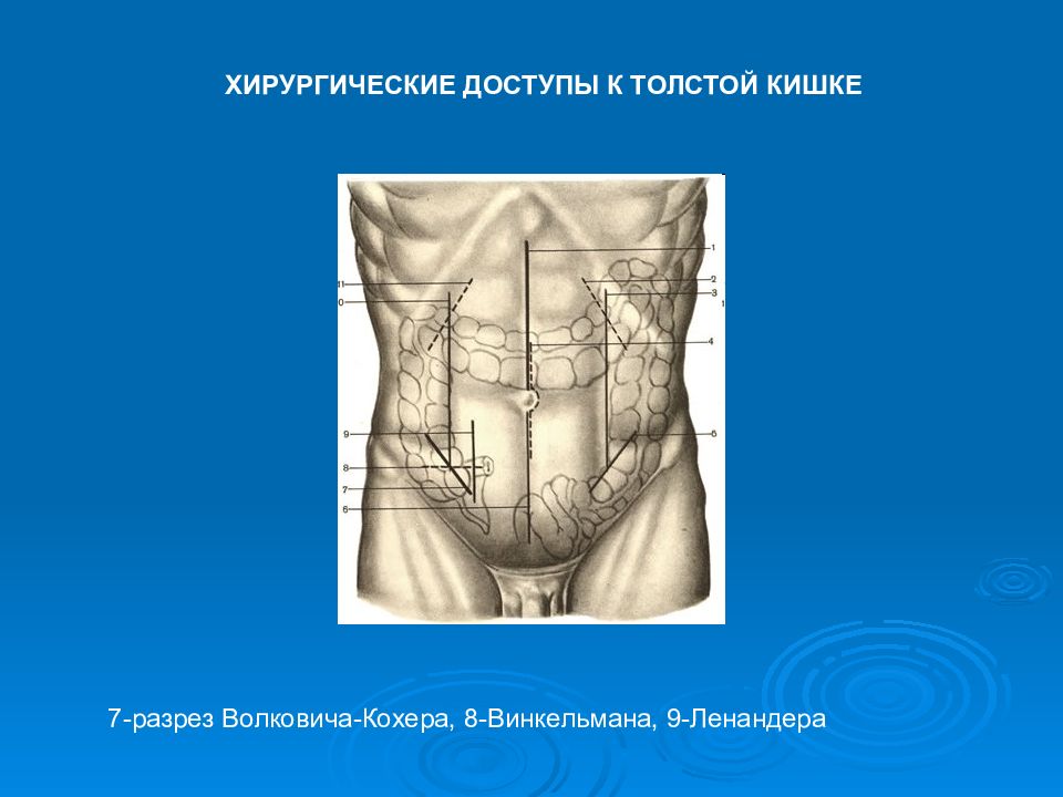 Кохер аппендицит