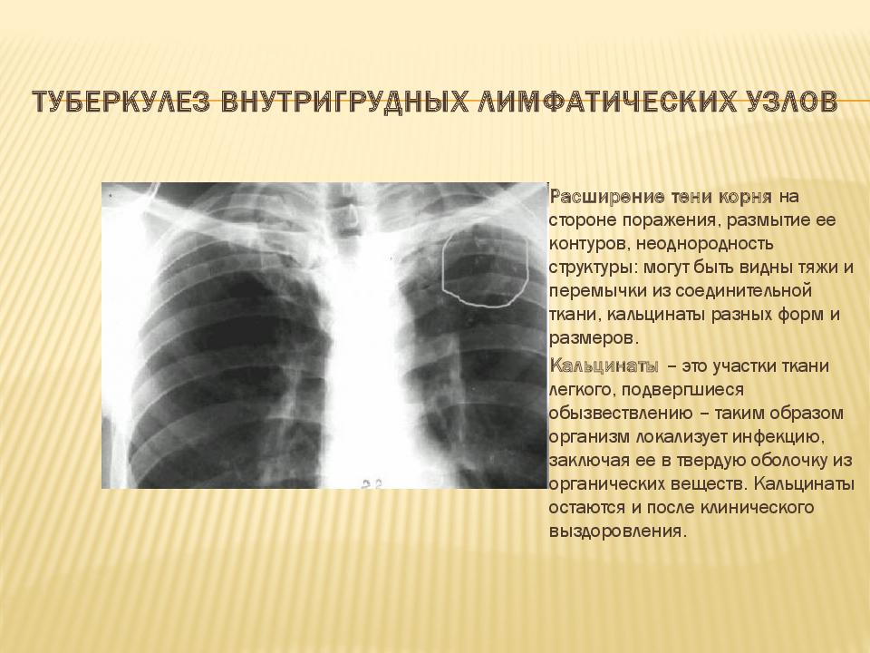 Кальцинаты в лимфоузлах. Малая форма туберкулеза внутригрудных лимфатических узлов рентген. Туберкулез внутригрудных лимфатических узлов с6. Туморозная форма туберкулеза внутригрудных лимфатических узлов. Осложнения туберкулеза внутригрудных лимфатических узлов.