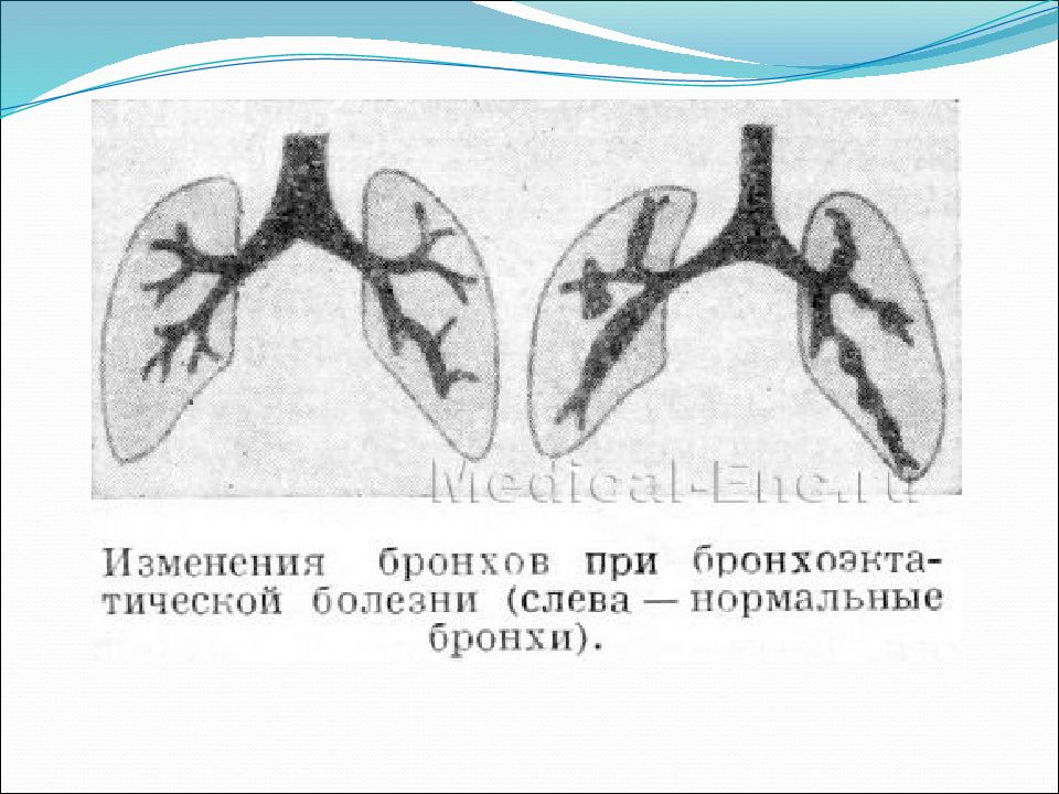 Бронхоэктатическая болезнь презентация