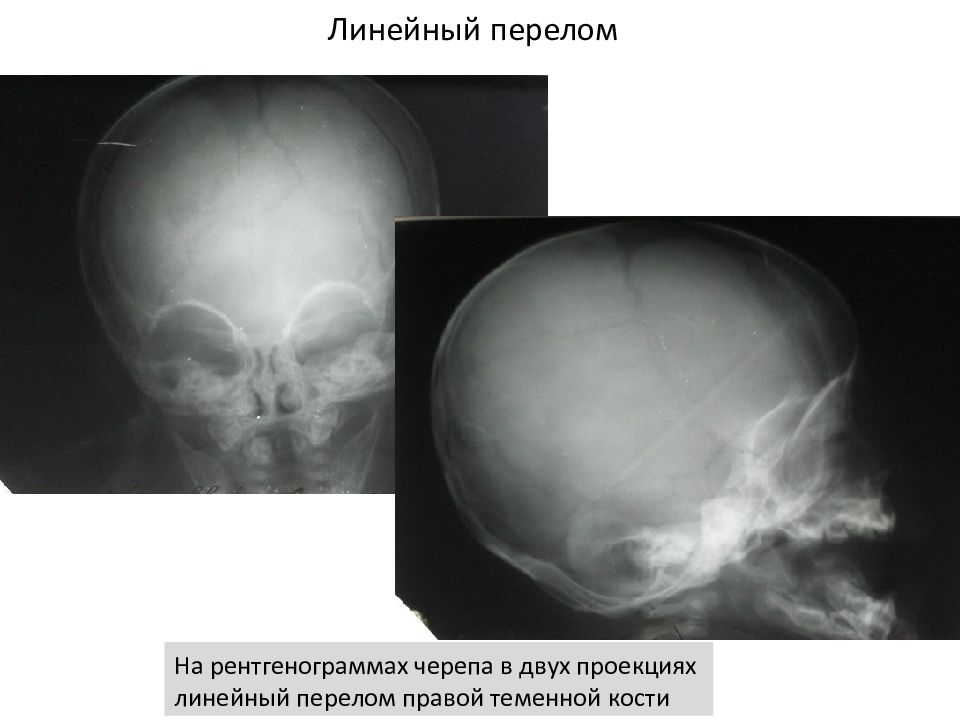 Линейный перелом свода черепа