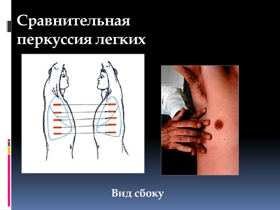 Перкуссия это. Перкуссия легких алгоритм. Сравнительная перкуссия легких сбоку. Сравнительная и топографическая перкуссия грудной клетки. Схема перкуссии легких.