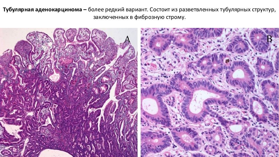 Фиброзная строма. Аденокарцинома желудка гистология. Низкодифференцированная аденокарцинома гистология. Аденокарцинома гистология. Низкодифференцированная аденокарцинома желудка гистология.