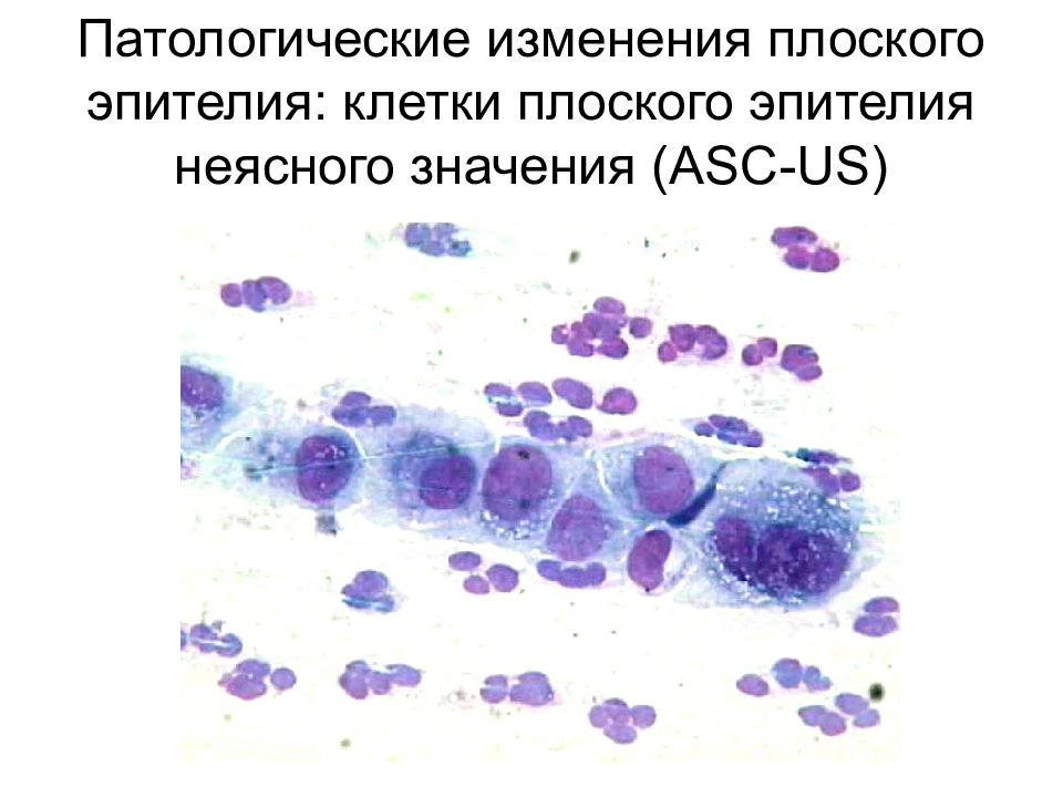 Цитологическая картина реактивных изменений эпителия слизистой оболочки воспалительного типа