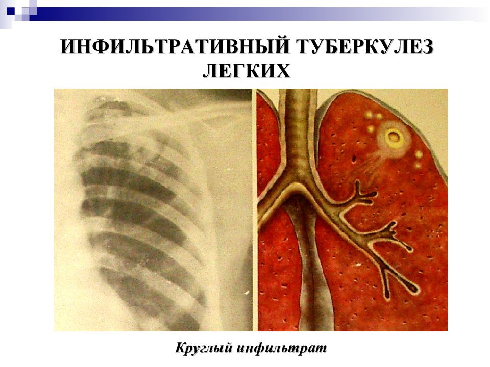 Инфильтративный туберкулез легких презентация