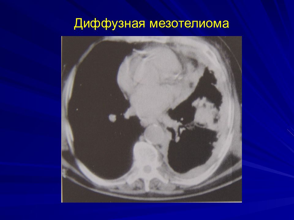 Мезотелиома брюшины. Канцероматоз мезотелиома брюшины. Диффузная мезотелиома. Мезотелиома брюшины кт. Мезотелиома брюшины мрт.