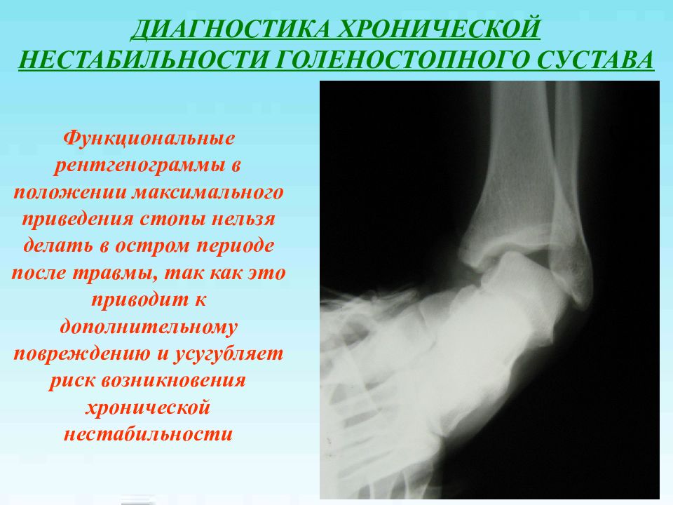 Диагноз голеностопный сустав. Нестабильность голеностопного сустава. Хроническая нестабильность голеностопного сустава. Нестабильность голеностопного сустава рентген. Нестабильный голеностопный сустав.