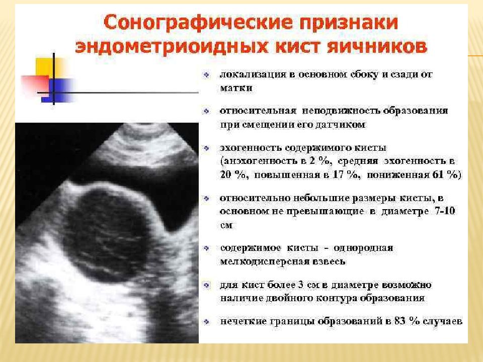 Право киста. Симптомы эндометриоз эндометриоидная киста. Эндометриоидная киста на УЗИ. Ультразвуковые признаки эндометриоидная киста яичника. Симптом кисты в кисте яичника.