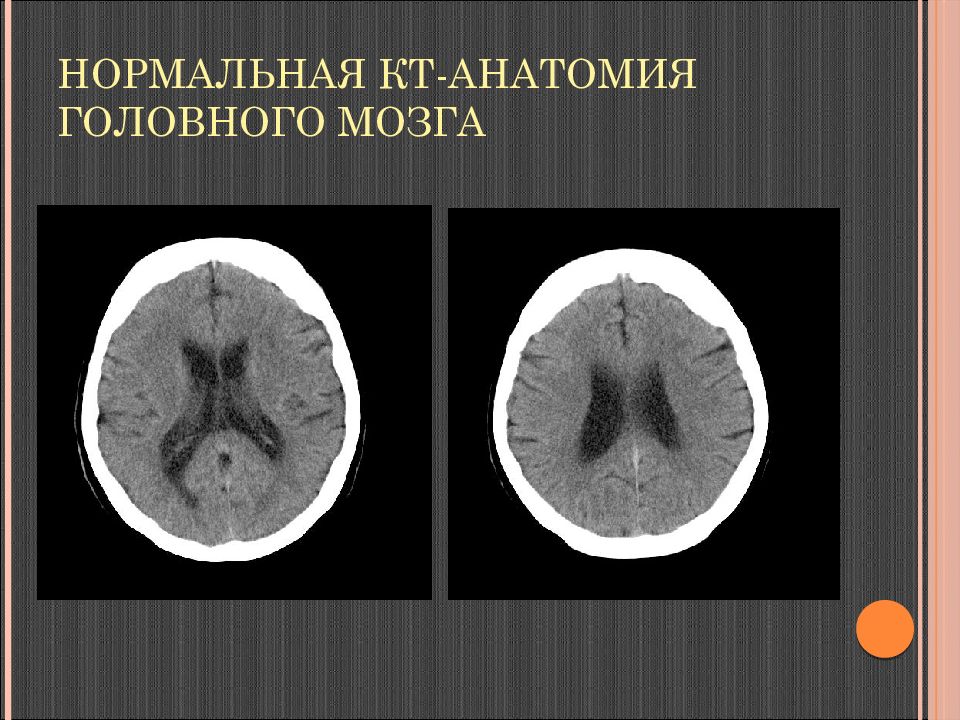 Норма мозга. Кт анатомия головного мозга. Нормальное кт головного мозга. Нормальная кт анатомия головного мозга. Кт головного мозга норма.