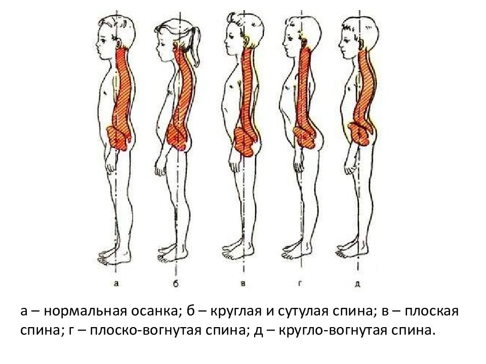 Плосковогнутая спина