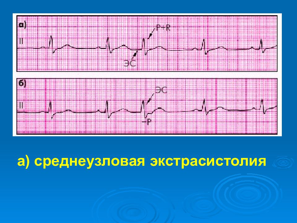 Риск экстрасистолии huawei. Среднеузловая экстрасистолия. ритм при экстрасистолии. экстрасистолия на экг. av экстрасистолия на экг.