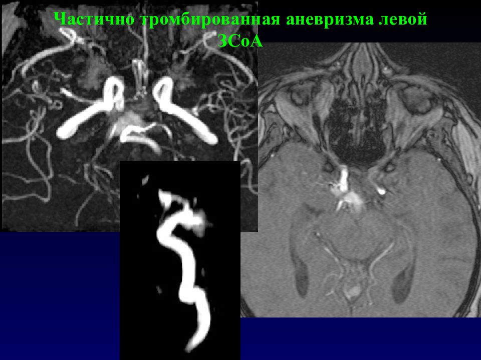 Аневризма. Тромбированная аневризма кт. Тромбированная аневризма мрт. Частично тромбированная аневризма.