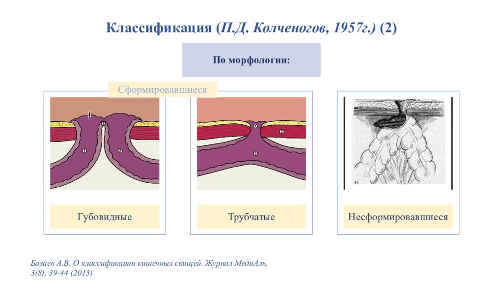 Лечение кишечных свищей