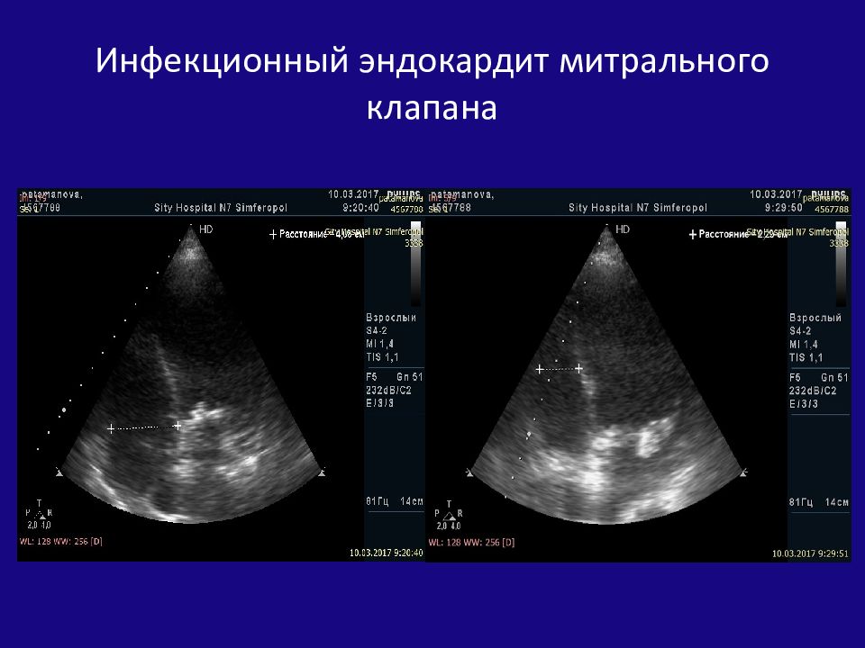 Эхо кс. Эндокардит митрального клапана ЭХОКГ. Инфекционный эндокардит эхокардиография. ЭХОКГ при инфекционном эндокардите. Инфекционный эндокардит митрального клапана.