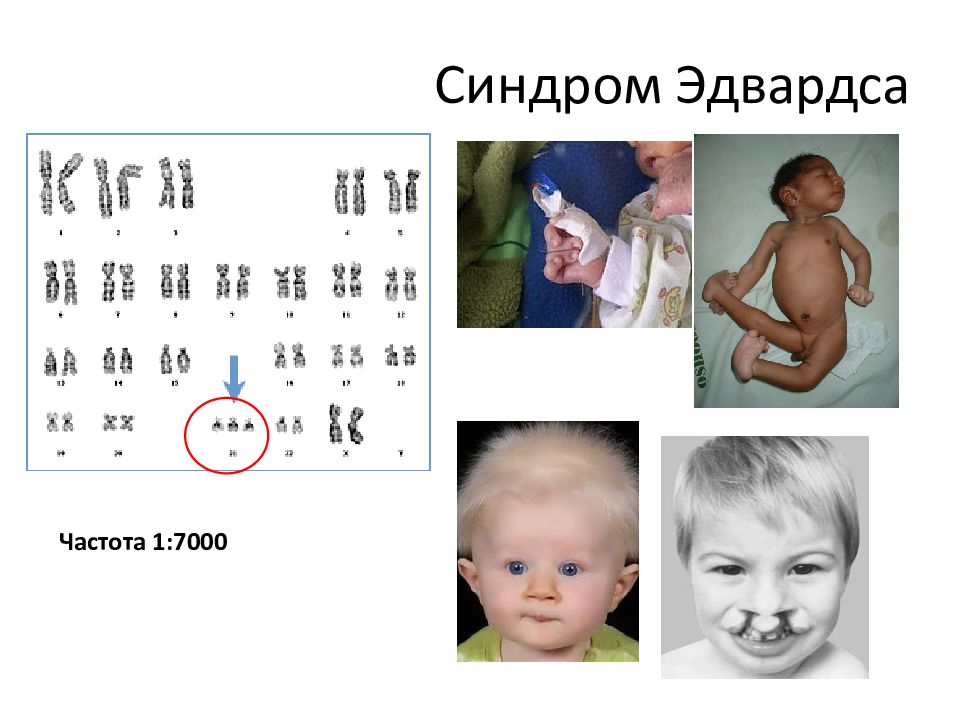 Карта фенотипа синдром дауна