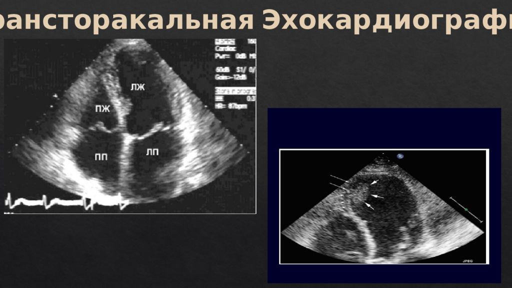 Эхокардиография Цена