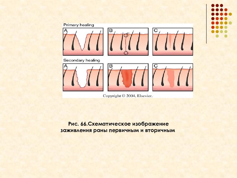 Вторичная рана. Вторичные швы срок заживления. Рана схематический рисунок. Самостоятельно не могут зажить раны диаметр которых.