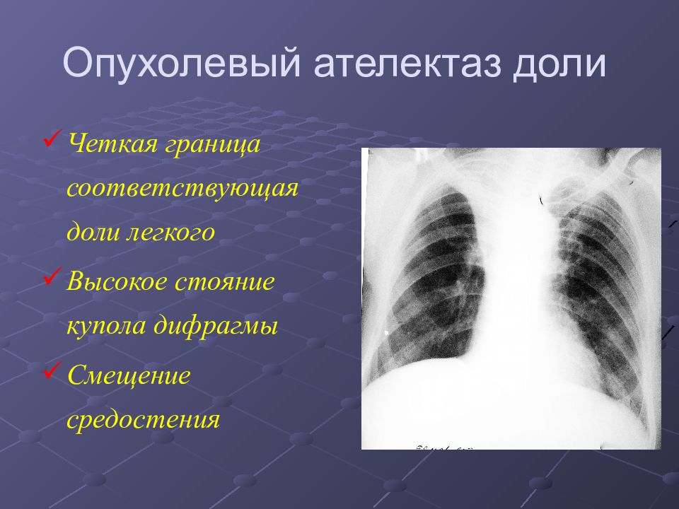 Ателектаз легкого. Обструктивный ателектаз. Компрессионный ателектаз рентген. Ателектаз правого легкого рентген. Ателектаз доли лёгкого.