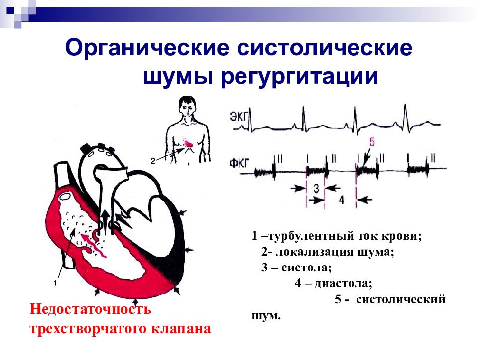 Аускультативная картина при трикуспидальной недостаточности