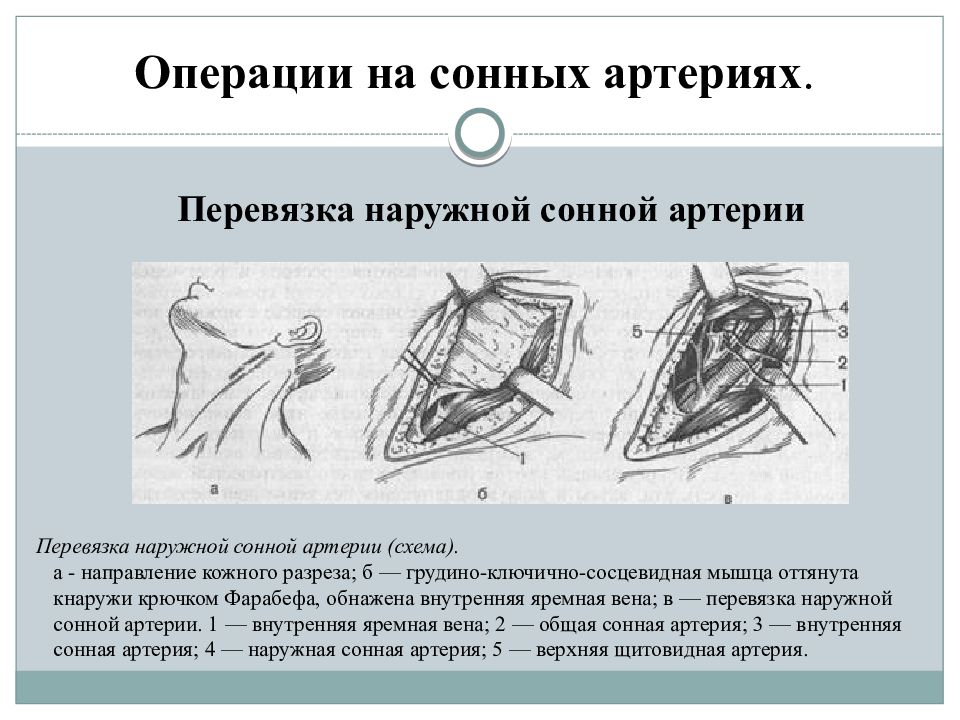 Операция на артерии