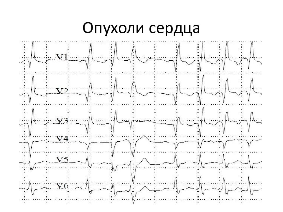 Подъем сегмента st