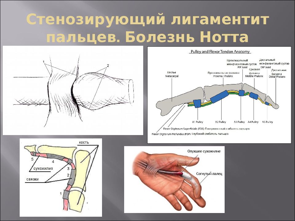 Ганглион мкб. Стенозирующий лигаментит. Стенозирующий лигаментит пальца кисти. Болезнь Нотт,стенозируюший ЛЕНГО. Стенозирующий лигаментит. Болезнь Нотта.