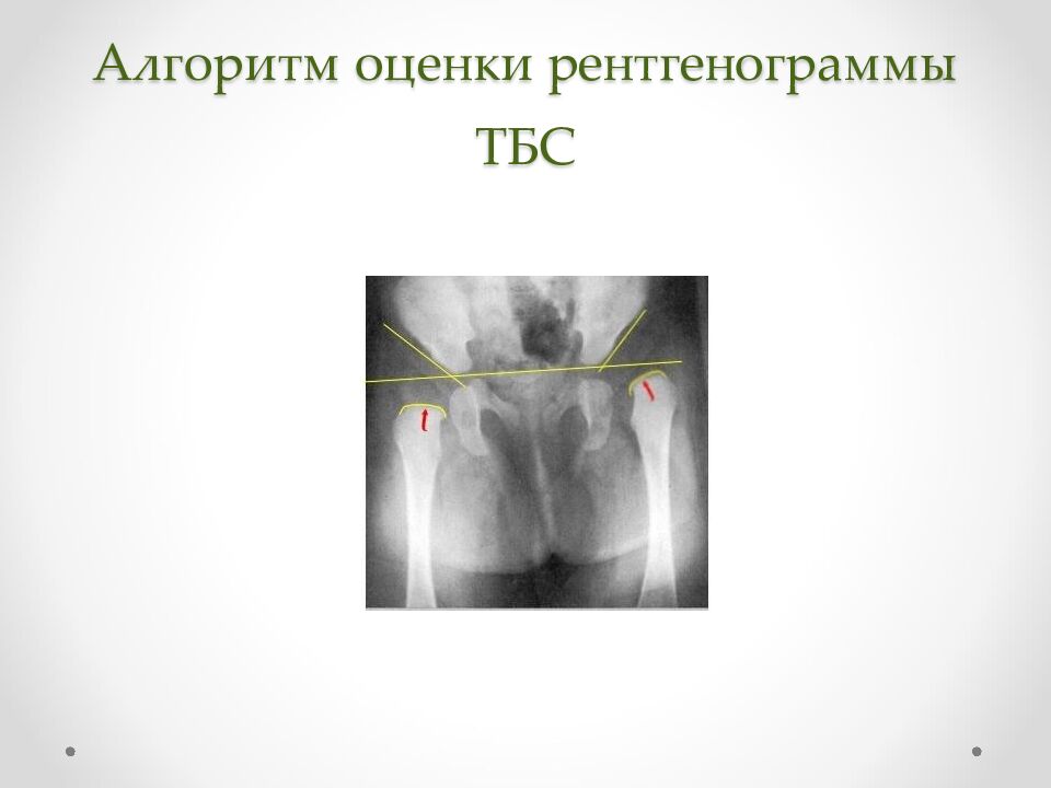 Алгоритм оценки рентгенограммы ТБС