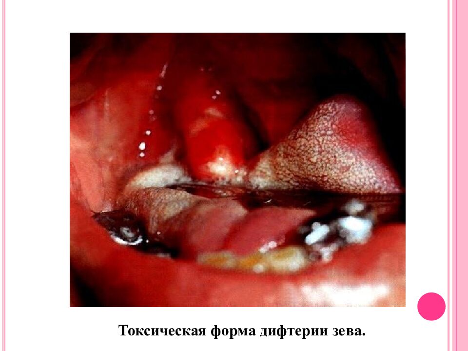 Токсическая форма дифтерии