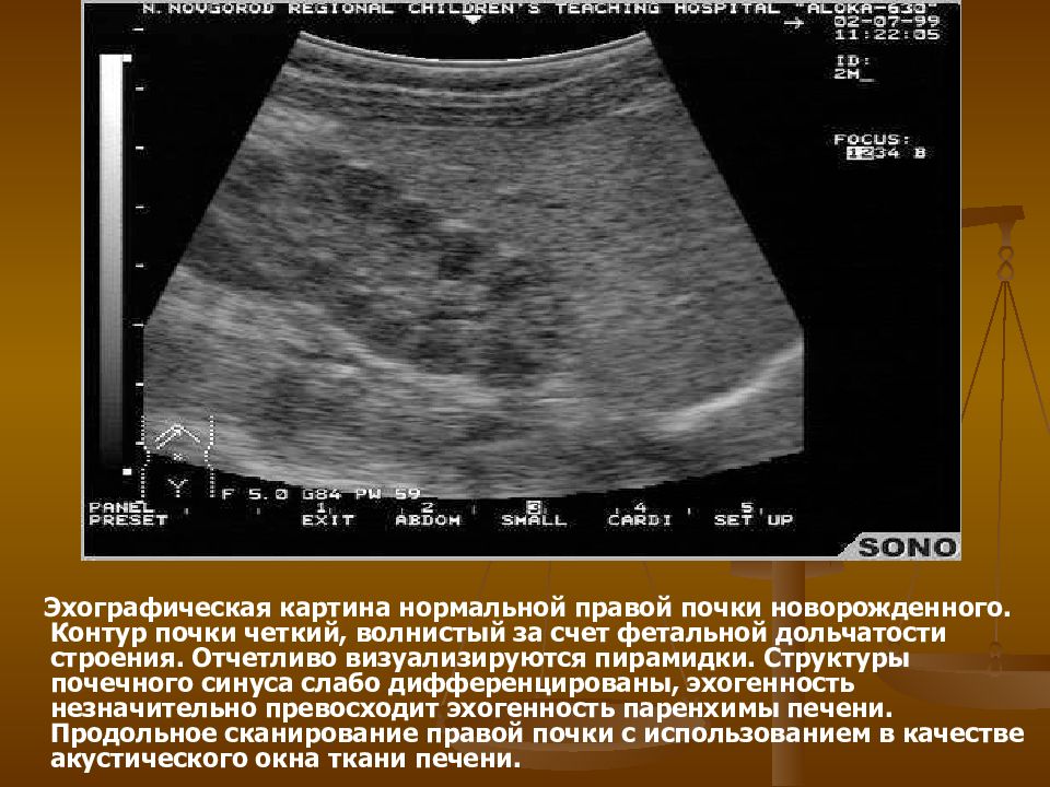 Эхографическую картину капиллярной гемангиомы печени необходимо дифференцировать с