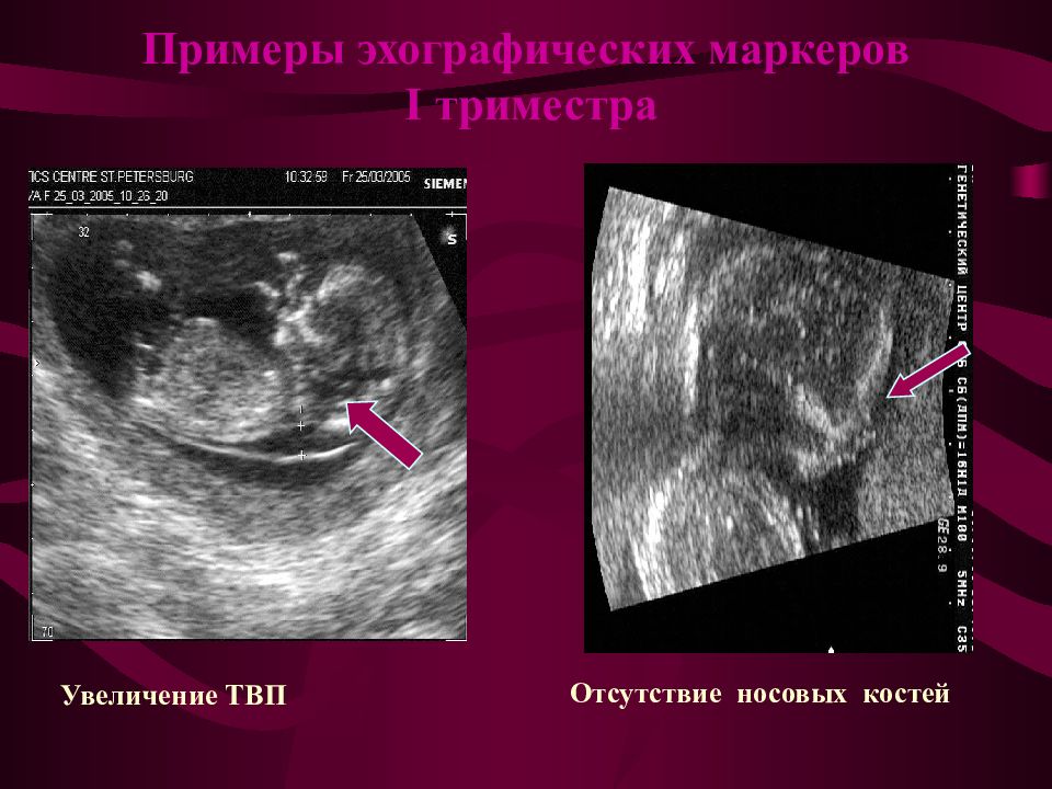 Воротниковая зона 12 недель