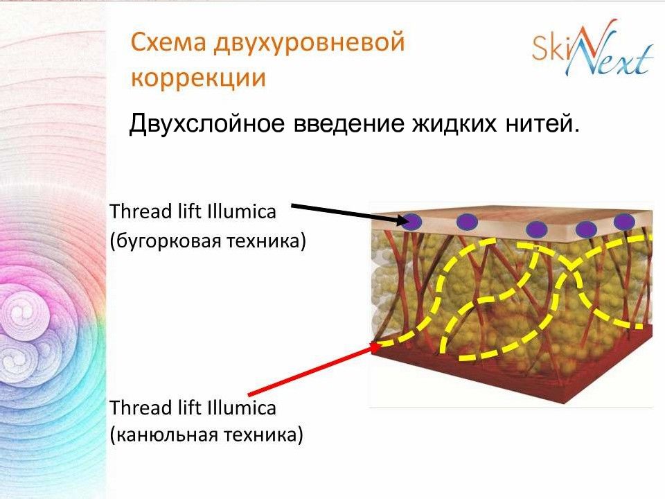 Жидкие мезонити схема введения