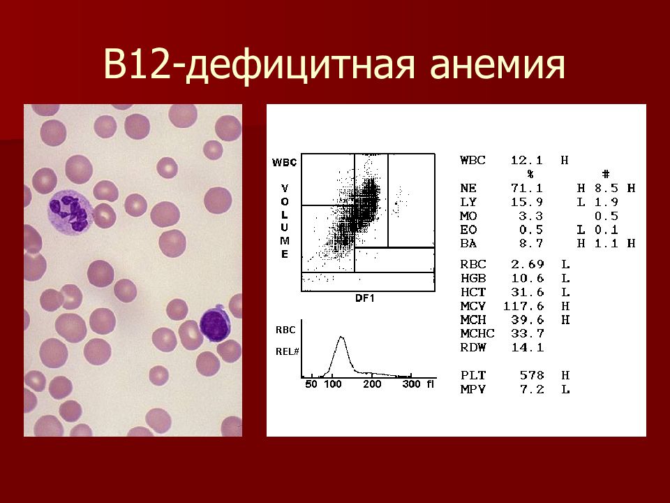 В12 дефицитная анемия. Витамин-b12-дефицитная анемия. B12 анемия ОАК. В12 дефицитная анемия кровь. Показатели крови при b12 дефицитной анемии.