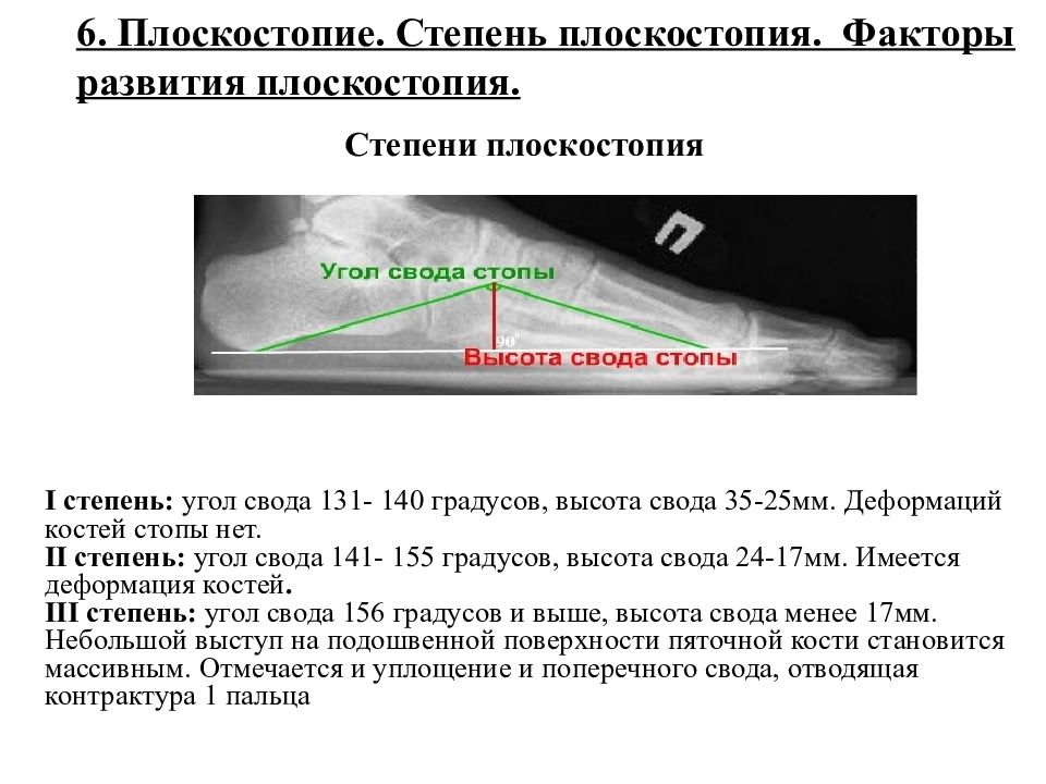 Угол стопы. Угол свода стопы. Степень плоскостопия по градусам. Факторы развития плоскостопия. Плоскостопие углы по степеням.