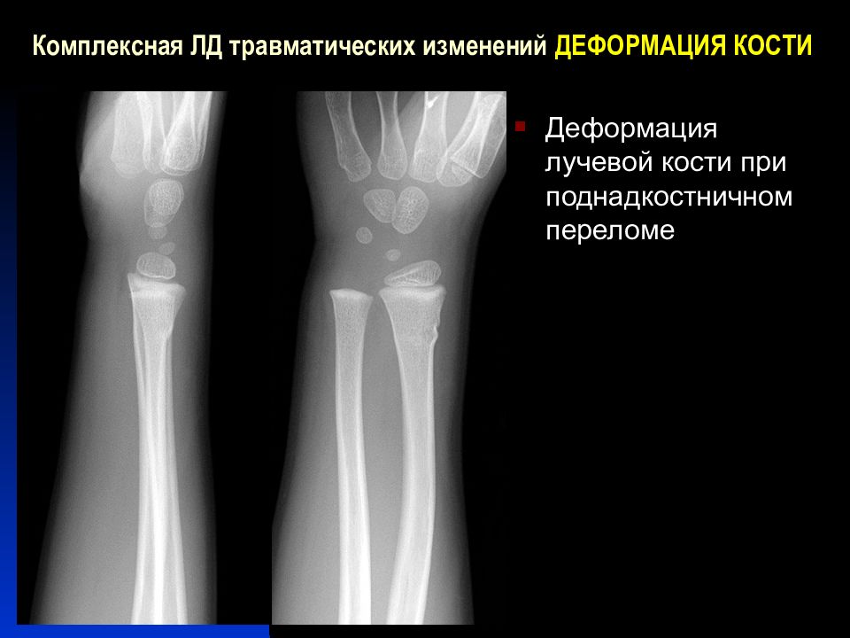 Деформация костей. Поднадкостничный перелом н/3 правой лучевой кости. Перелом поднадкостничный перелом лучевой кости. Поднадкостничный перелом рентген.