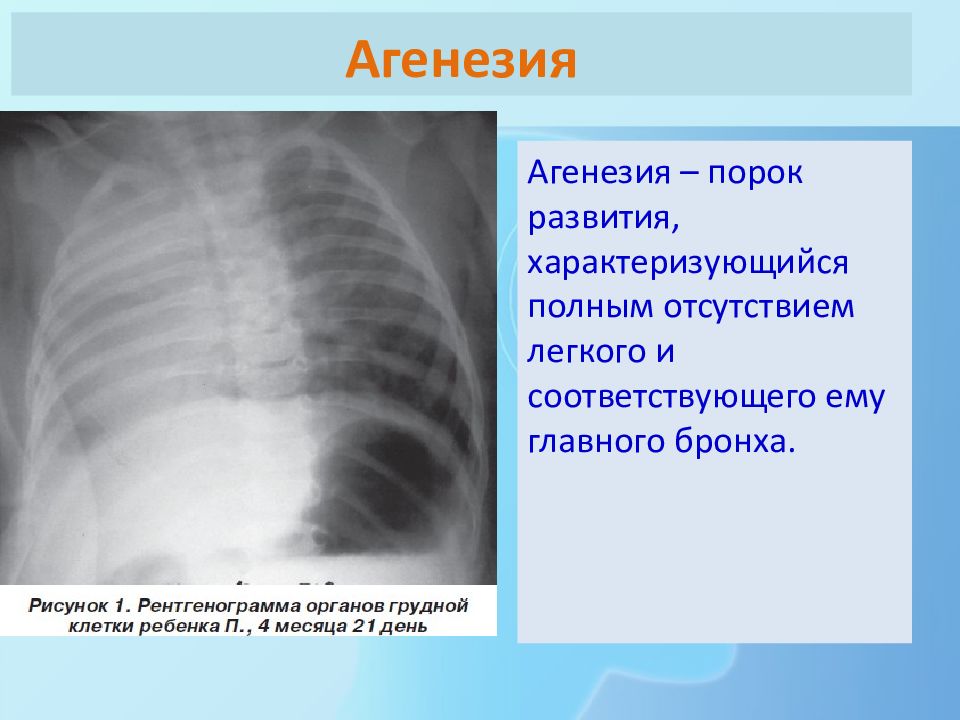 Врожденные пороки развития дыхательной системы презентация