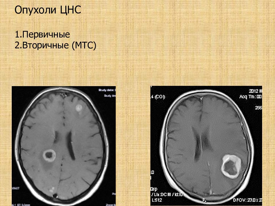 Опухоль мозга презентация