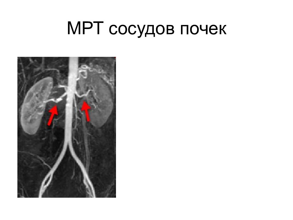 Аберрантная почечная артерия. Сосуды почек.