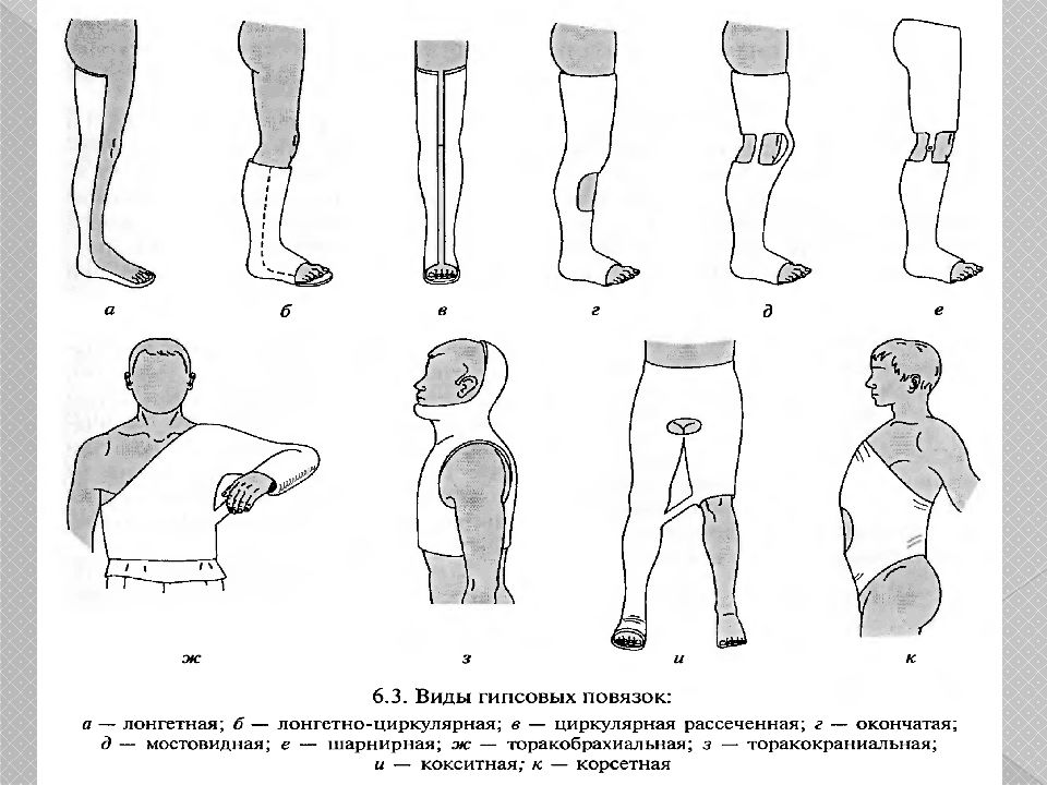 Гипсовые повязки презентация