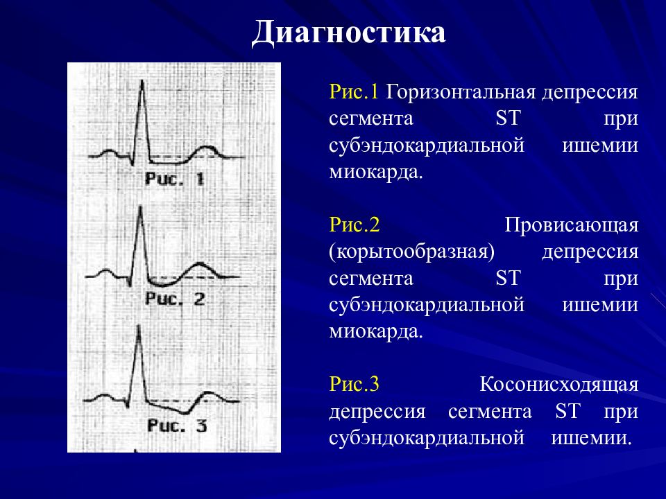 Депрессия сегмента st