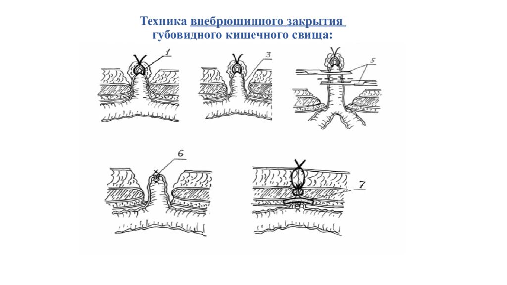 Свищ послеоперационный карта вызова