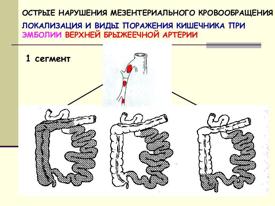 Острые нарушения мезентериального кровообращения презентация