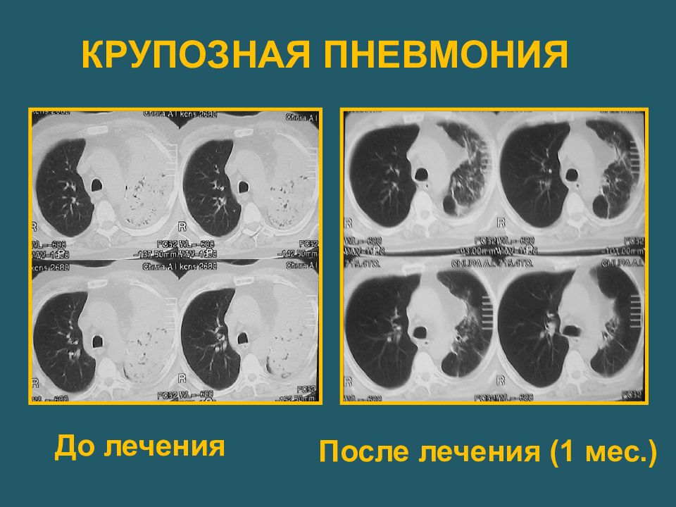 Кт картина пневмонии