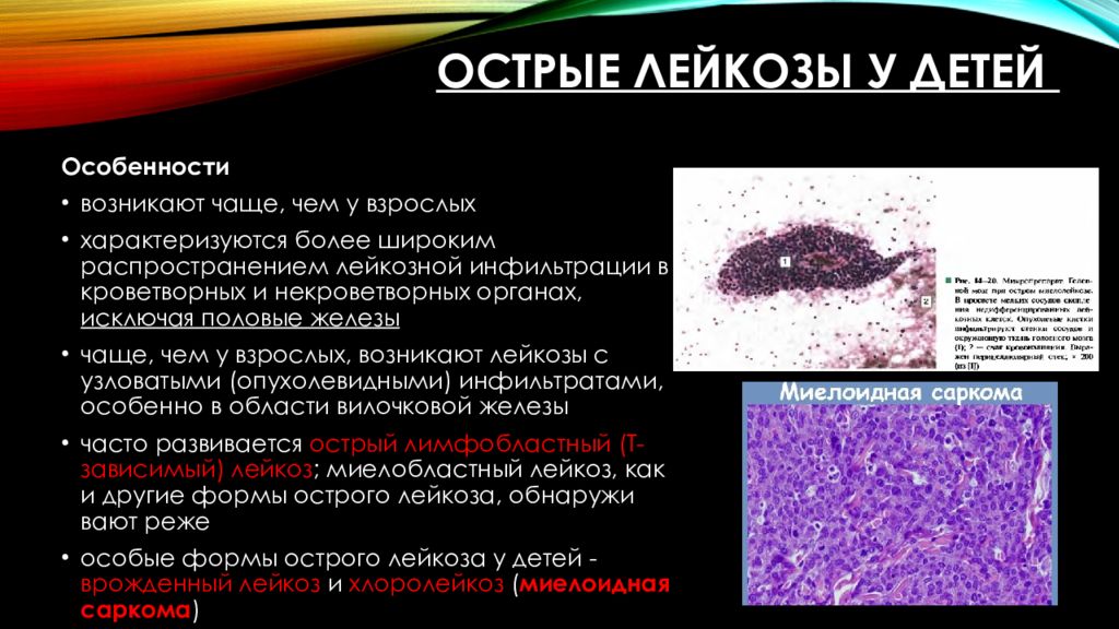 Типы острых лейкозов. Острый лейкоз презентация. Острый лейфообразный лейкоз.