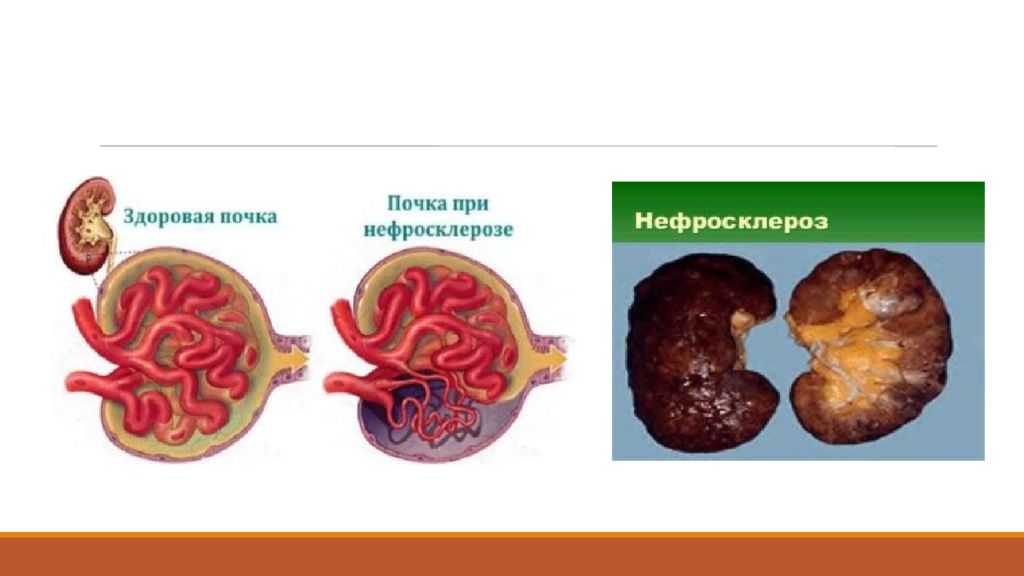 Уремическая кома презентация