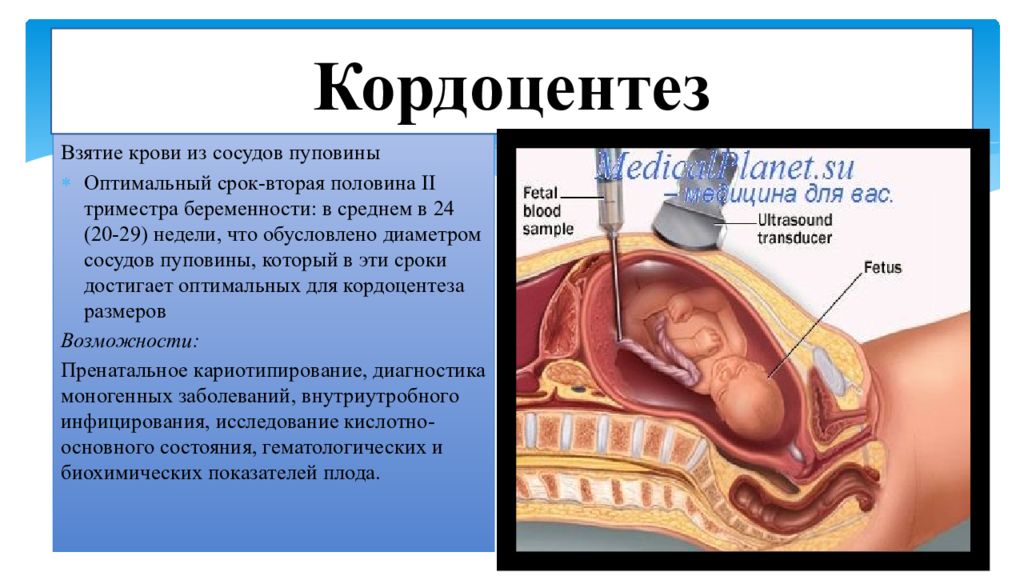 В пуповине расположены сосуды. Кордоцентез сущность метода. Инвазивные методы пренатальной диагностики. Кордоцентез презентация.