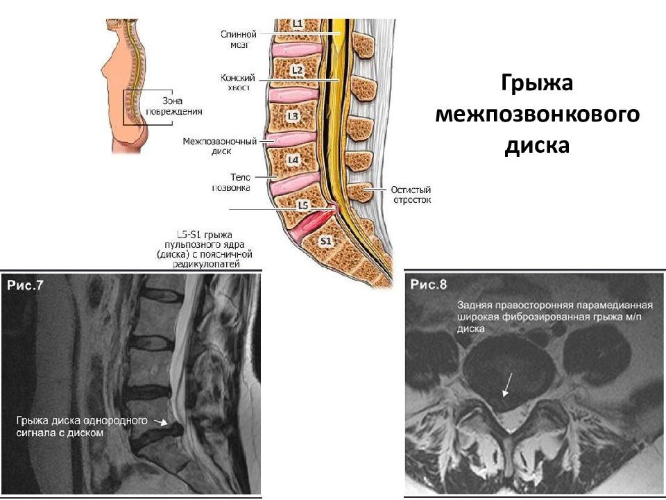 Диагноз ддзп поясничного отдела позвоночника. Дорсалгия грудного поясничного отдела. Ддзп грудного отдела позвоночника. Диагноз дорсалгия поясничного отдела позвоночника.