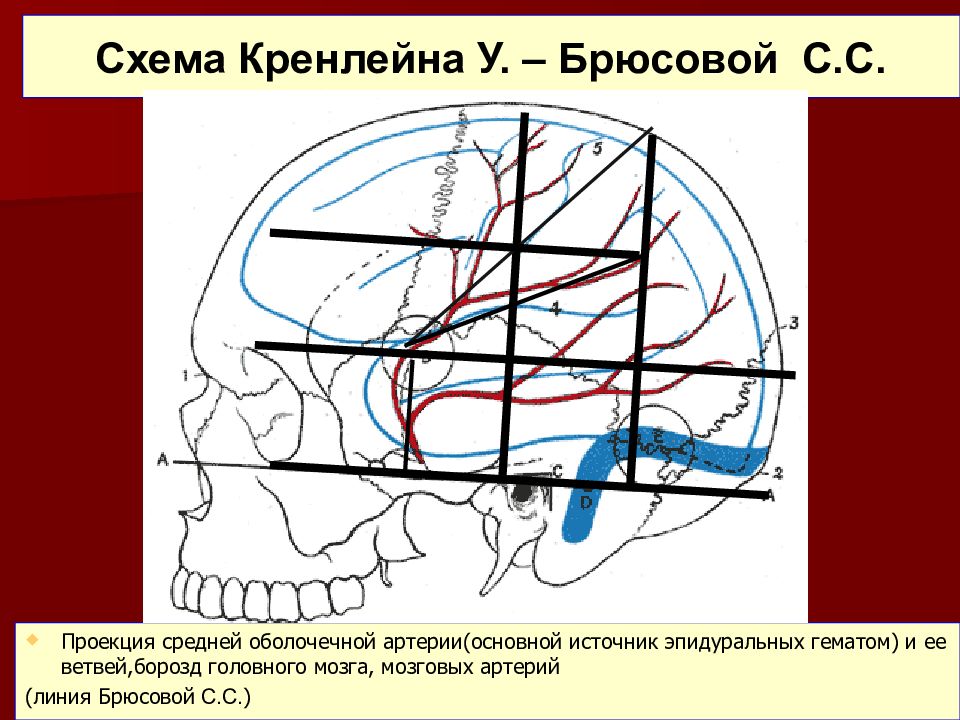 Схема кренлейна черепно мозговая