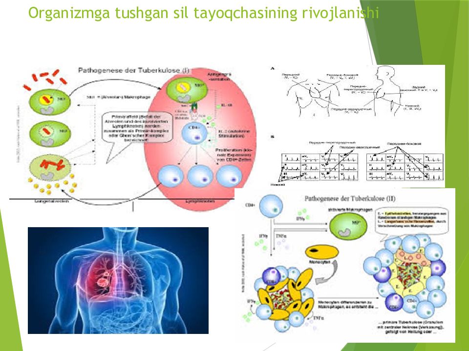 O'PKA OBSTRUKTIV YETISHMOVCHILIGI DIAGNOSTIKASI Organizmga tushgan sil tayoqchasining rivojlanishi