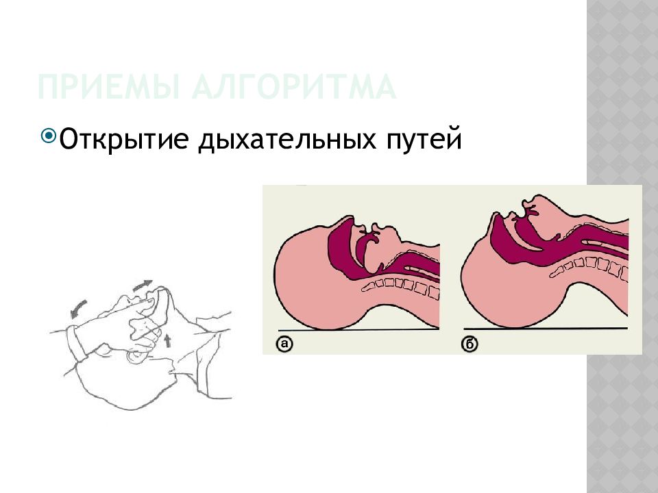 Для открытия дыхательных. Открытие дыхательных путей. Способы открывания дыхательных путей. Опишите метод открытия дыхательных путей. Открытие дыхательных путей Сафара.