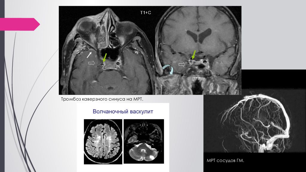 Синус тромбоз мрт. Тромбоз синусов головного мозга кт. Мрт презентация.