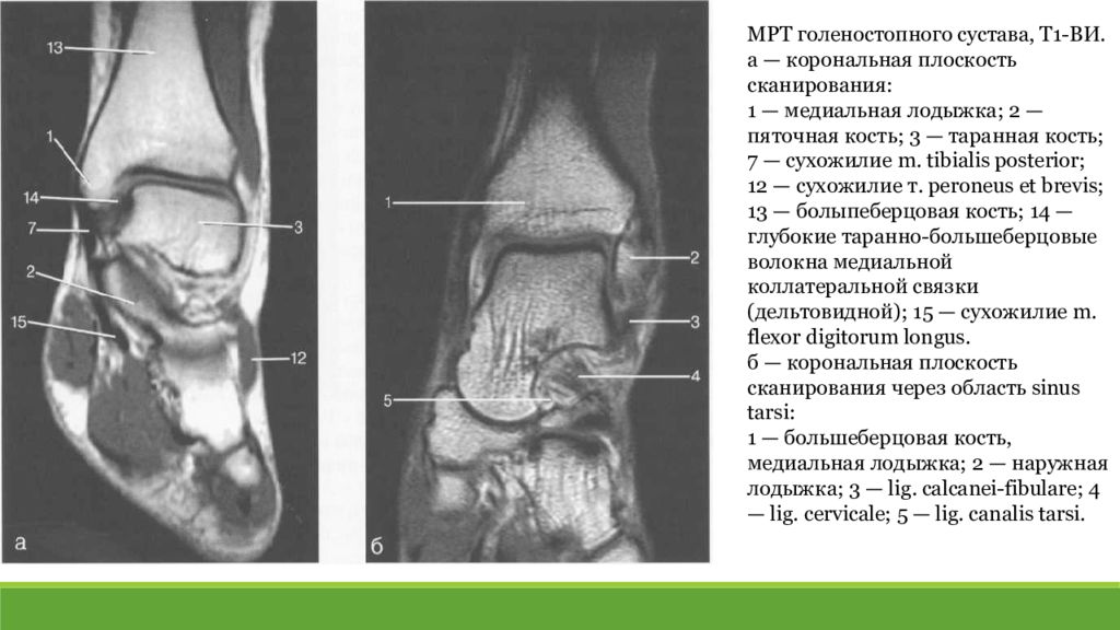 Мрт голеностопного. Анатомия таранной кости мрт. Анатомия голеностопного сустава мрт. Таранная кость кт анатомия.